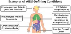 Examples of AIDS-defining conditions, included in the Centers for Disease Control and Prevention’s list of diagnostic criteria for AIDS.
