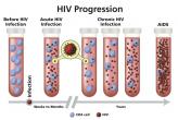 Graphic of HIV progression: before infection, acute HIV infection, chronic HIV infection, and AIDS.