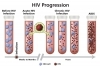 La evolución de la infección por el VIH al SIDA ilustrada con tubos de ensayo, células CD4, y partículas del virus. 