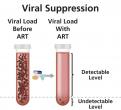 An HIV infection is suppressed to undetectable levels with HIV treatment.