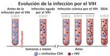 La evolución de la infección por el VIH al SIDA ilustrada con tubos de ensayo, células CD4, y partículas del virus. 