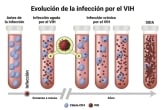 La evolución de la infección por el VIH al SIDA ilustrada con tubos de ensayo, células CD4, y partículas del virus. 