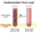 An HIV infection is suppressed to undetectable levels with HIV treatment.