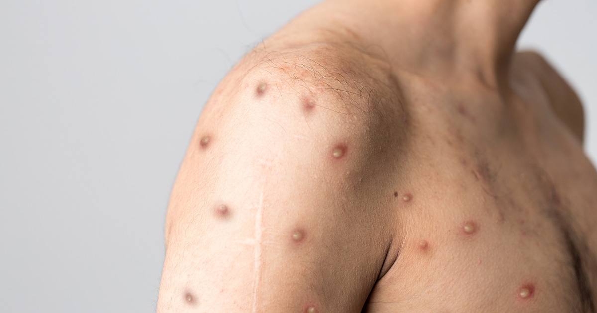 Mpox skin lesions.