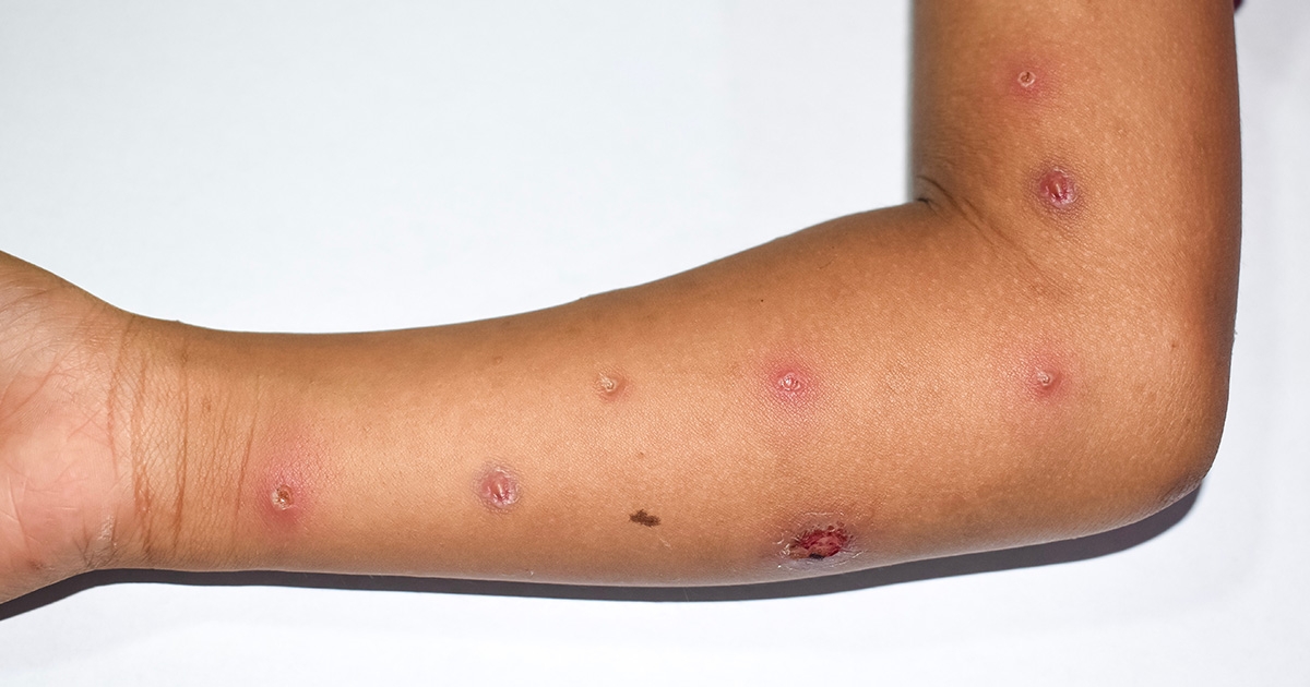 Mpox skin rash on pediatric patients arm. 