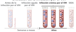 La evolución de la infección por el VIH al SIDA ilustrada con tubos de ensayo, células CD4, y partículas del virus.
