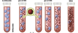 La evolución de la infección por el VIH al SIDA ilustrada con tubos de ensayo, células CD4, y partículas del virus. 