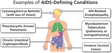 Examples of AIDS-defining conditions, included in the Centers for Disease Control and Prevention’s list of diagnostic criteria for AIDS.