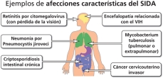 Ejemplos de condiciones que definen el SIDA, incluidas en la lista de criterios de diagnóstico del SIDA de los Centros para el Control y la Prevención de Enfermedades