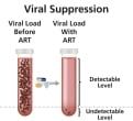 HIV viral load is reduced to an undetectable level with ART.
